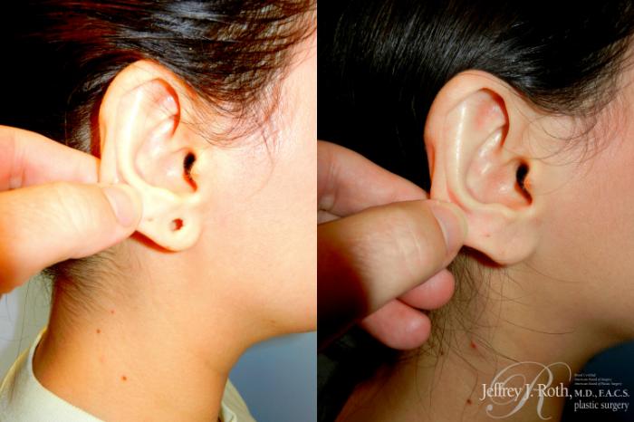 Before & After Earlobe Repair Surgery Case 287 Right Side w/ Pull View in Las Vegas and Henderson, NV