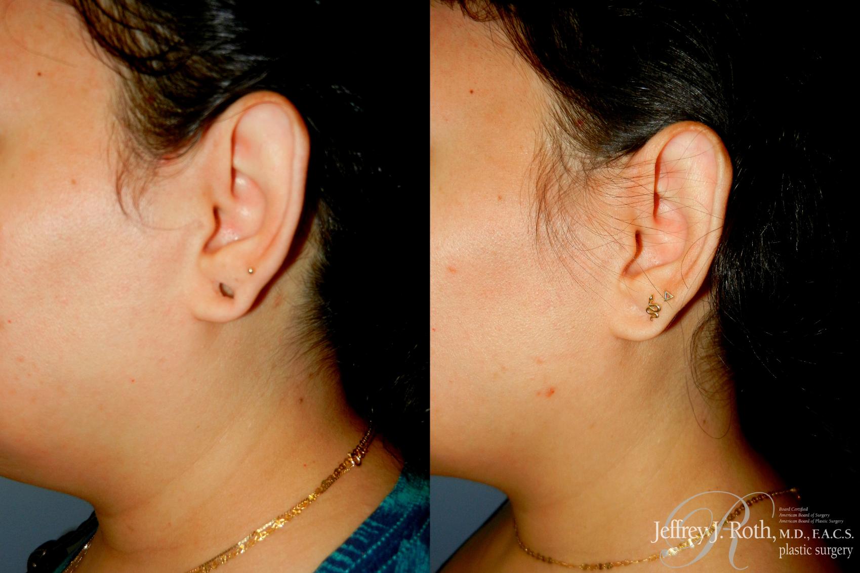 Before & After Earlobe Repair Surgery Case 294 Left Side View in Las Vegas and Henderson, NV