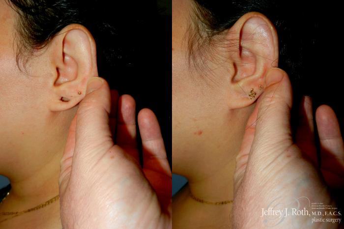 Before & After Earlobe Repair Surgery Case 294 Left Side w/ Pull View in Las Vegas and Henderson, NV