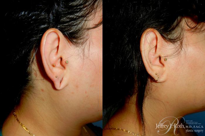 Before & After Earlobe Repair Surgery Case 294 Right Side View in Las Vegas and Henderson, NV