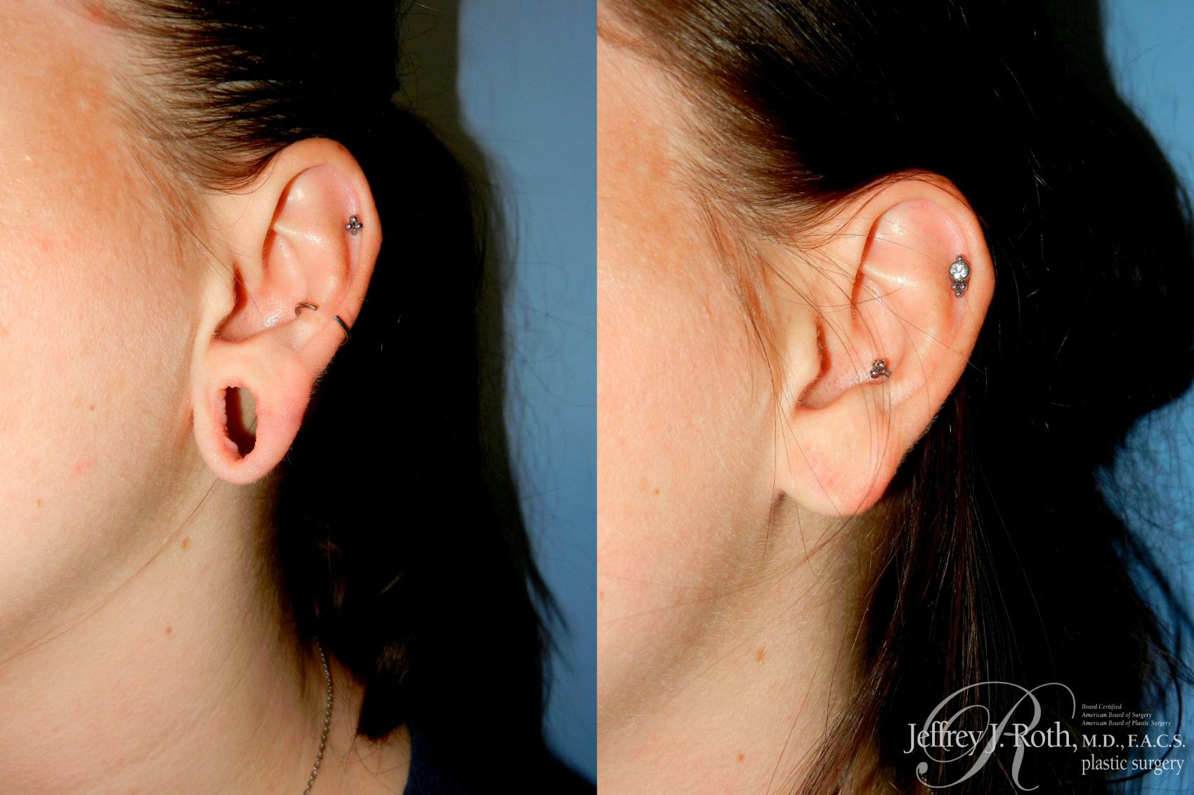Before & After Earlobe Repair Surgery Case 328 Left Oblique View in Las Vegas and Henderson, NV