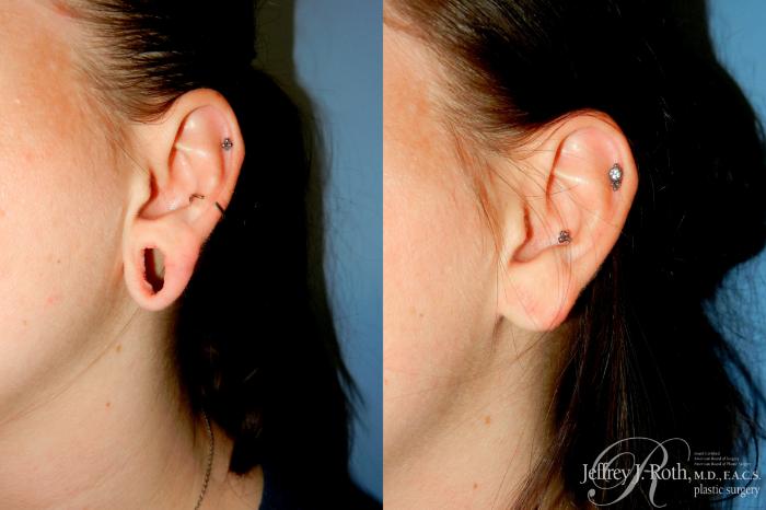 Before & After Earlobe Repair Surgery Case 328 Left Oblique View in Las Vegas and Henderson, NV
