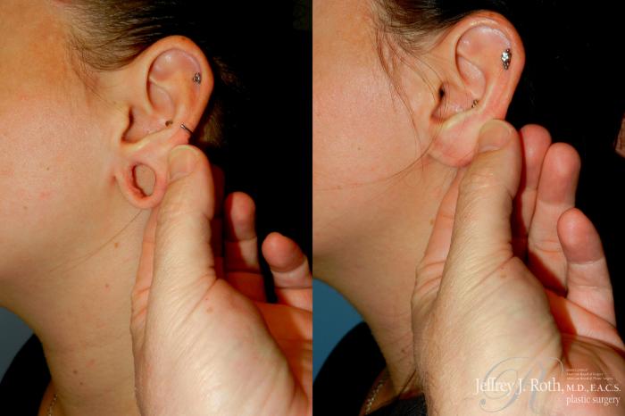 Before & After Earlobe Repair Surgery Case 328 Left Side 2 View in Las Vegas and Henderson, NV