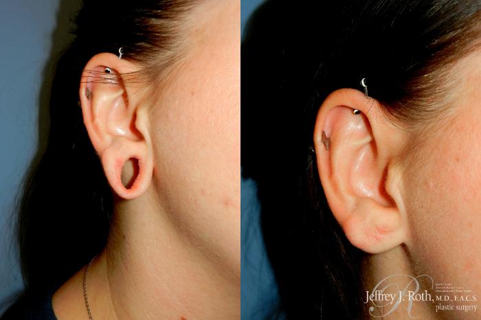 Before & After Earlobe Repair Surgery Case 328 Right Oblique View in Las Vegas and Henderson, NV
