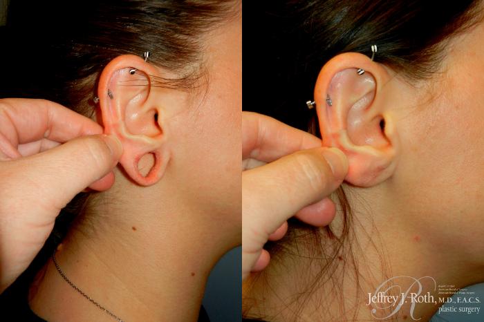 Before & After Earlobe Repair Surgery Case 328 Right Side View in Las Vegas and Henderson, NV