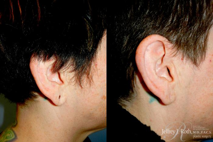 Before & After Earlobe Repair Surgery Case 345 Right Side View in Las Vegas and Henderson, NV