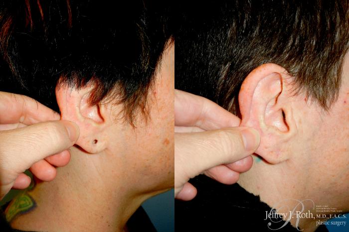 Before & After Earlobe Repair Surgery Case 345 RIGHT SIDE W/ PULL View in Las Vegas and Henderson, NV