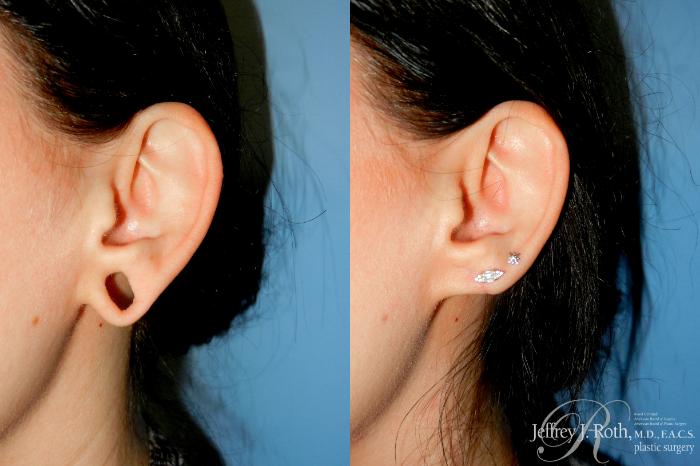 Before & After Earlobe Repair Surgery Case 350 Left Oblique View in Las Vegas and Henderson, NV
