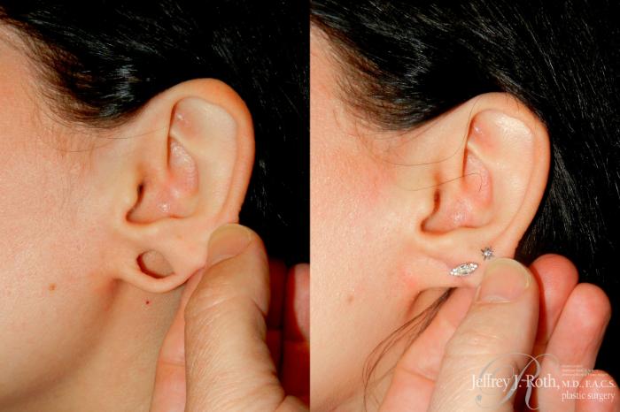 Before & After Earlobe Repair Surgery Case 350 LEFT W/ PULL View in Las Vegas and Henderson, NV