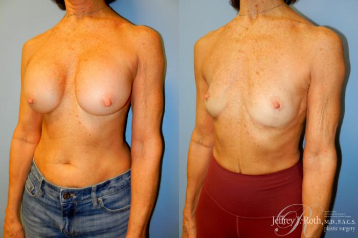 Before & After Breast Lift Case 253 Left Oblique View in Las Vegas and Henderson, NV