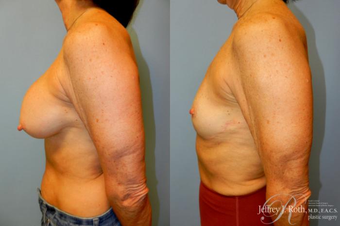 Before & After Breast Lift Case 253 Left Side View in Las Vegas and Henderson, NV