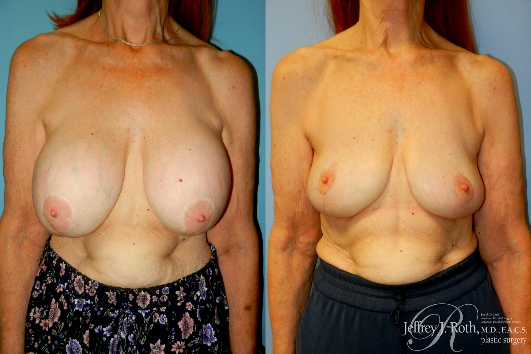 Before & After Explant Surgery Case 313 Front View in Las Vegas and Henderson, NV