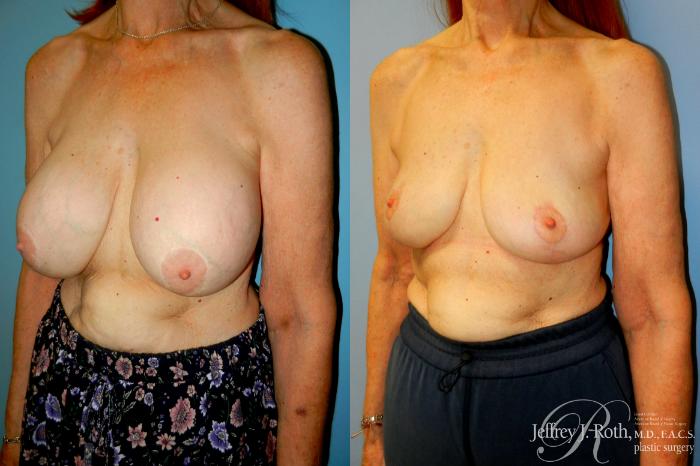 Before & After Explant Surgery Case 313 Left Oblique View in Las Vegas and Henderson, NV