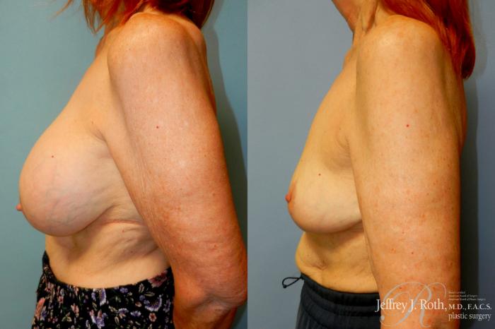 Before & After Explant Surgery Case 313 Left Side View in Las Vegas and Henderson, NV