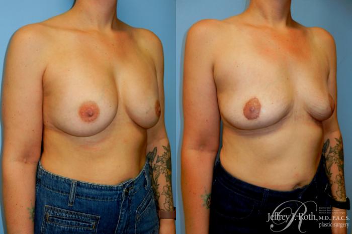 Before & After Explant Surgery Case 319 Right Oblique View in Las Vegas and Henderson, NV