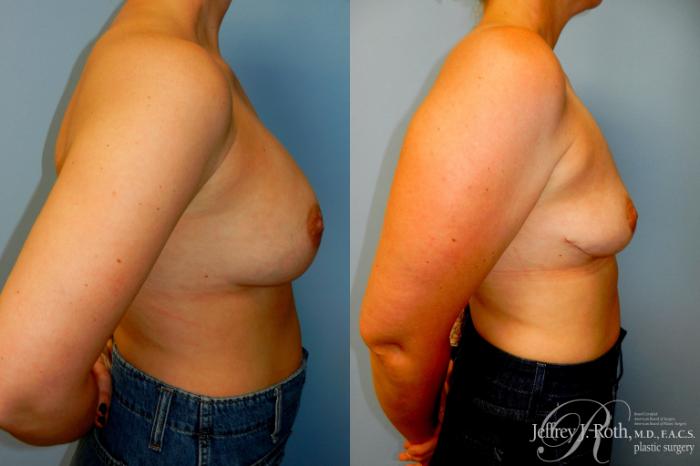 Before & After Explant Surgery Case 319 Right Side View in Las Vegas and Henderson, NV