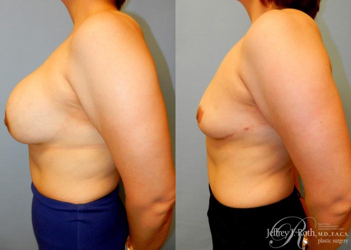 Before & After Explant Surgery Case 54 View #3 View in Las Vegas and Henderson, NV