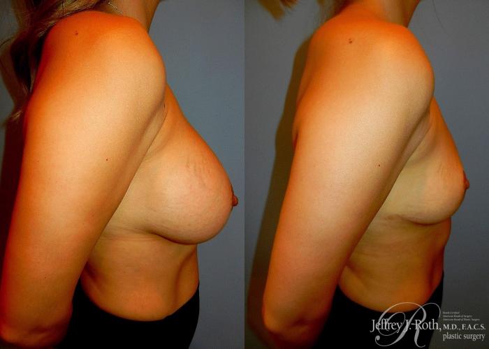 Before & After Explant Surgery Case 55 View #3 View in Las Vegas and Henderson, NV