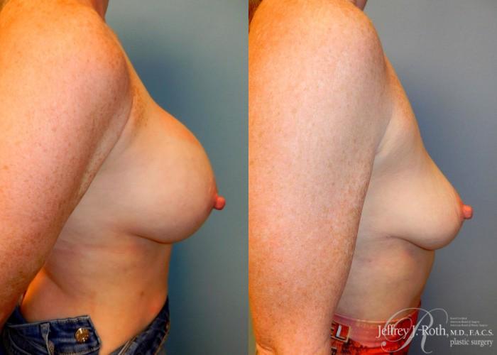 Before & After Explant Surgery Case 56 View #3 View in Las Vegas and Henderson, NV