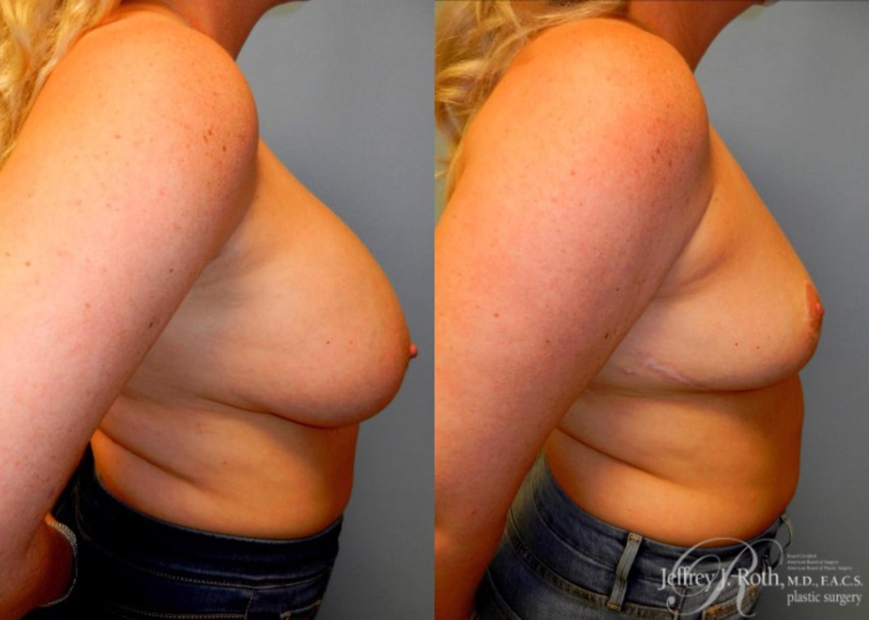 Before & After Explant Surgery Case 57 View #3 View in Las Vegas, NV