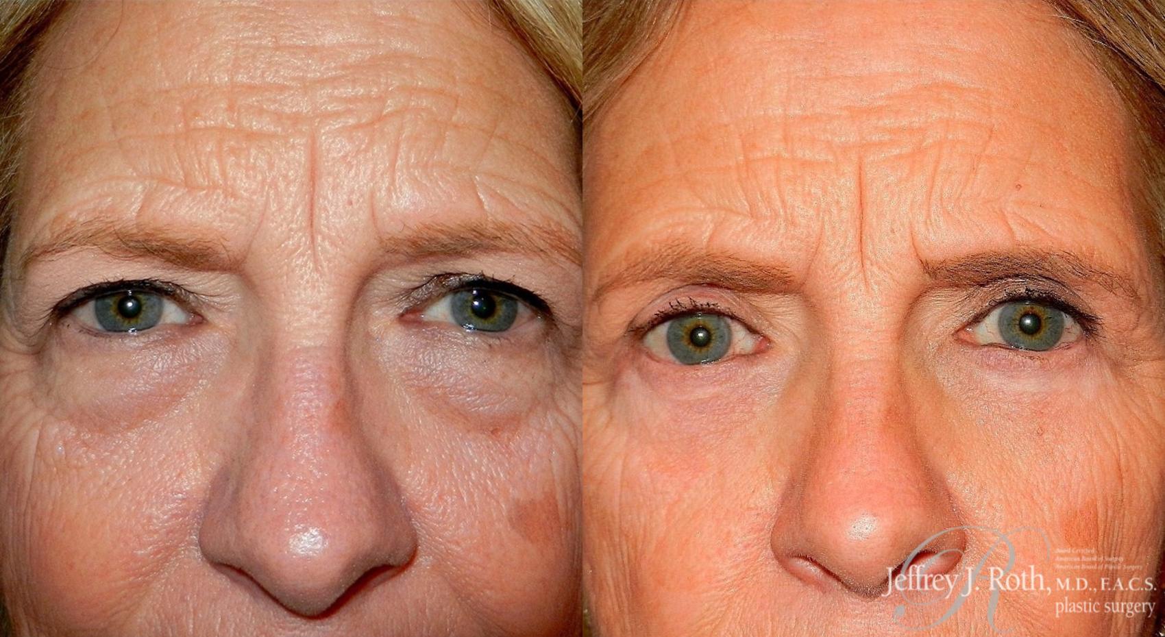 Before & After Eyelid Surgery Case 129 View #1 View in Las Vegas, NV