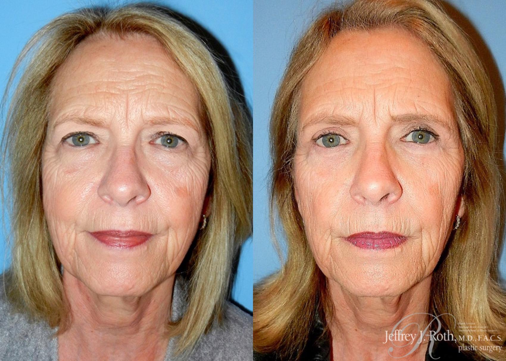 Before & After Eyelid Surgery Case 129 View #2 View in Las Vegas, NV