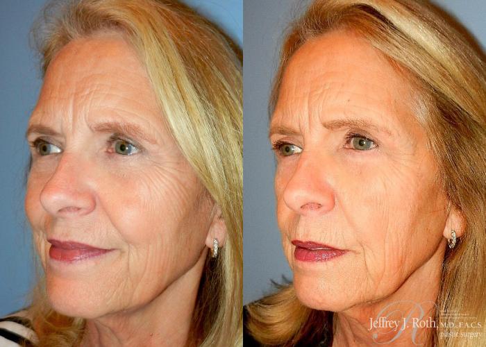 Before & After Eyelid Surgery Case 129 View #3 View in Las Vegas, NV
