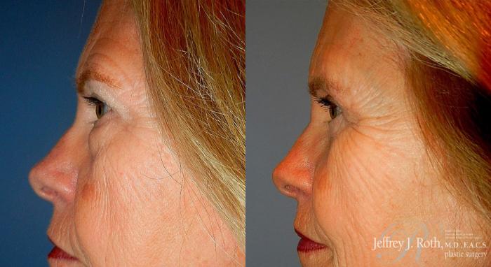Before & After Eyelid Surgery Case 129 View #4 View in Las Vegas, NV