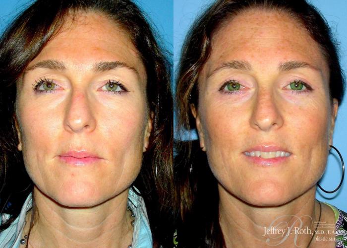 Before & After Eyelid Surgery Case 130 View #2 View in Las Vegas and Henderson, NV