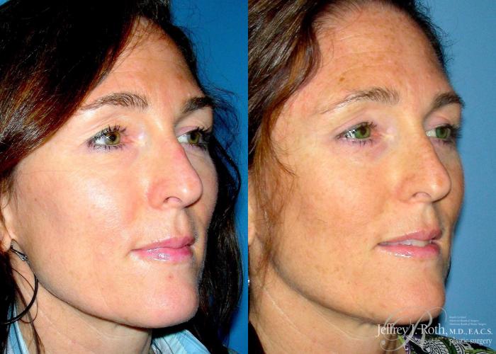 Before & After Eyelid Surgery Case 130 View #3 View in Las Vegas and Henderson, NV