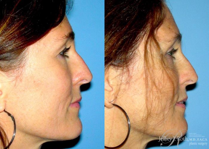 Before & After Eyelid Surgery Case 130 View #4 View in Las Vegas and Henderson, NV