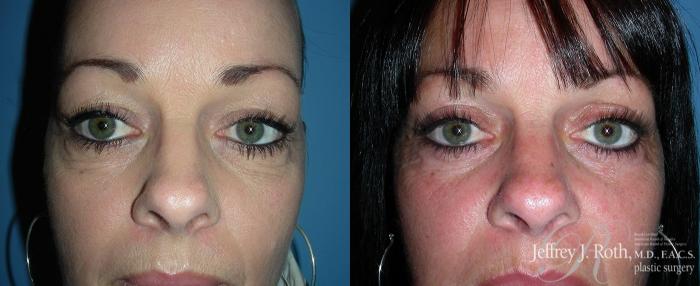 Before & After Eyelid Surgery Case 131 View #2 View in Las Vegas, NV