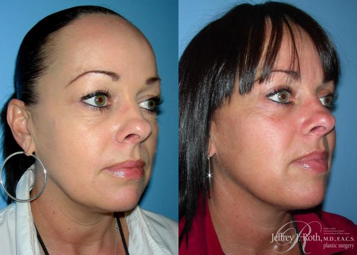 Before & After Eyelid Surgery Case 131 View #3 View in Las Vegas, NV