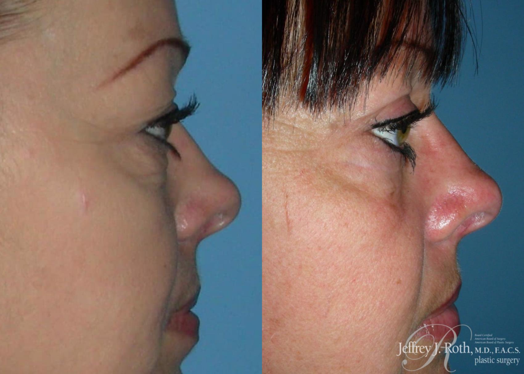 Before & After Eyelid Surgery Case 131 View #4 View in Las Vegas, NV