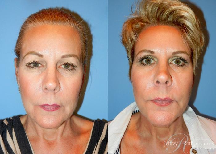 Before & After Eyelid Surgery Case 132 View #1 View in Las Vegas, NV