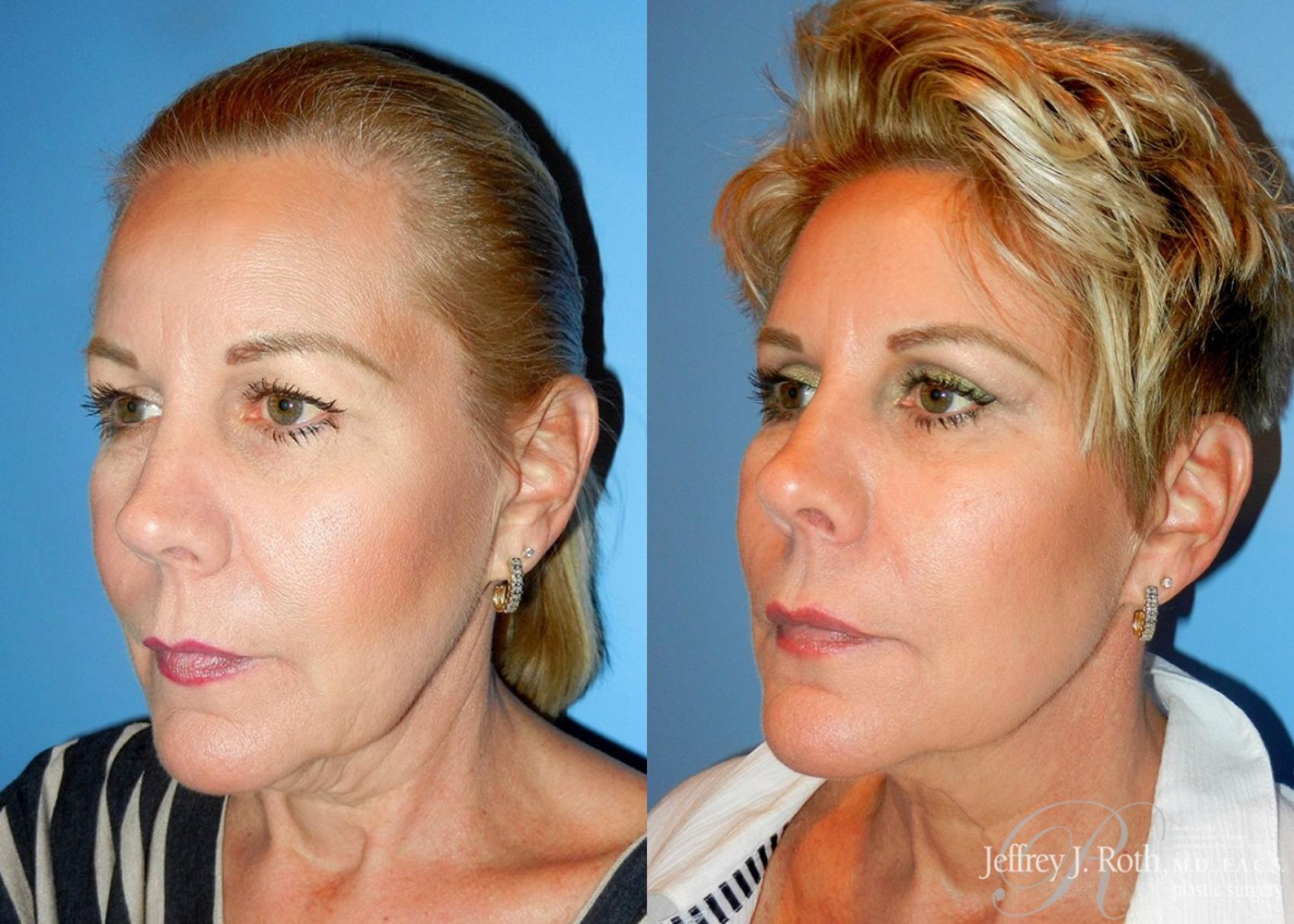 Before & After Eyelid Surgery Case 132 View #2 View in Las Vegas, NV