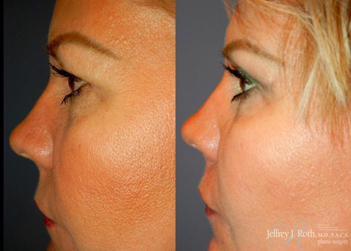 Before & After Eyelid Surgery Case 132 View #3 View in Las Vegas and Henderson, NV