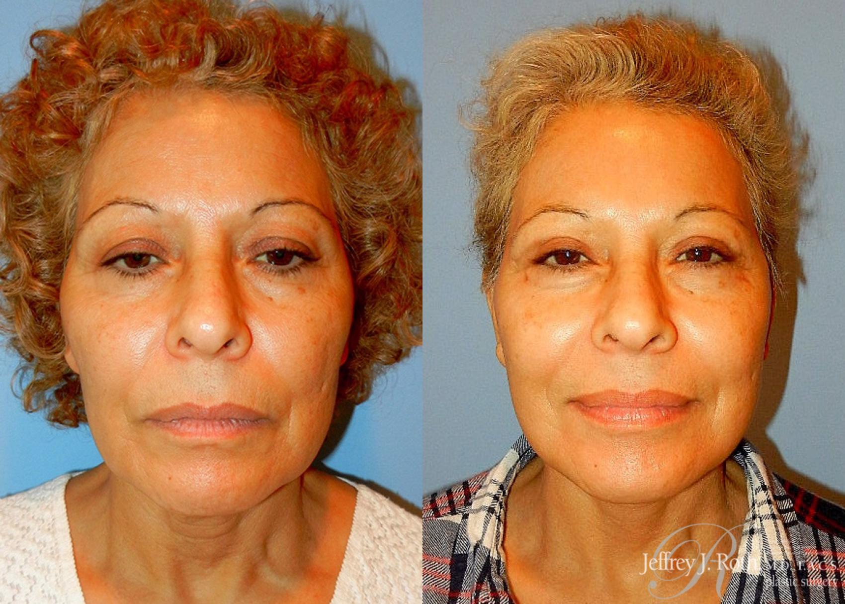 Before & After Eyelid Surgery Case 133 View #1 View in Las Vegas, NV
