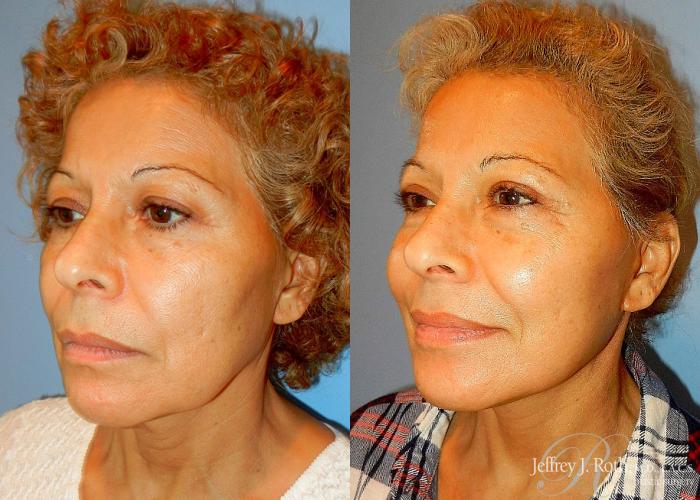 Before & After Eyelid Surgery Case 133 View #2 View in Las Vegas and Henderson, NV