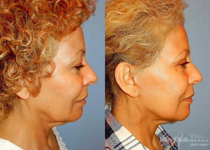 Before & After Eyelid Surgery Case 133 View #3 View in Las Vegas and Henderson, NV