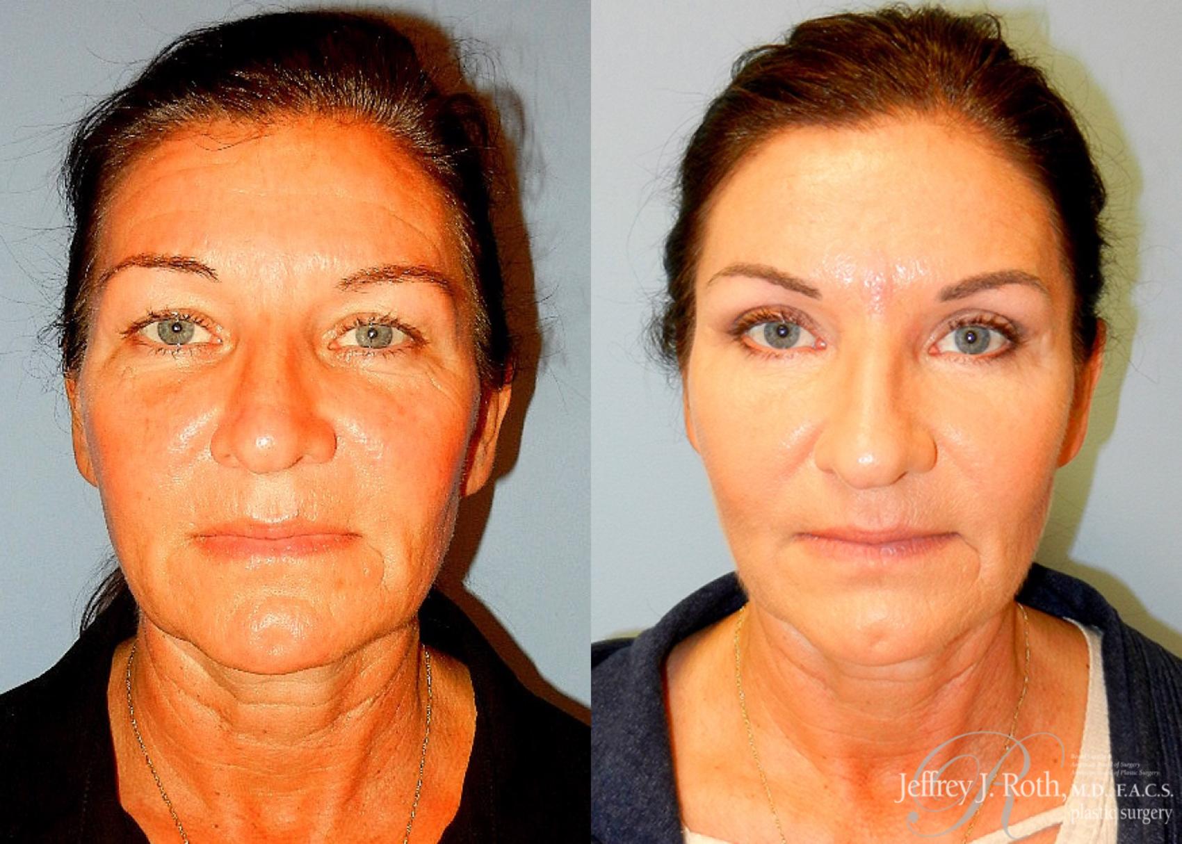 Before & After Eyelid Surgery Case 134 View #1 View in Las Vegas, NV