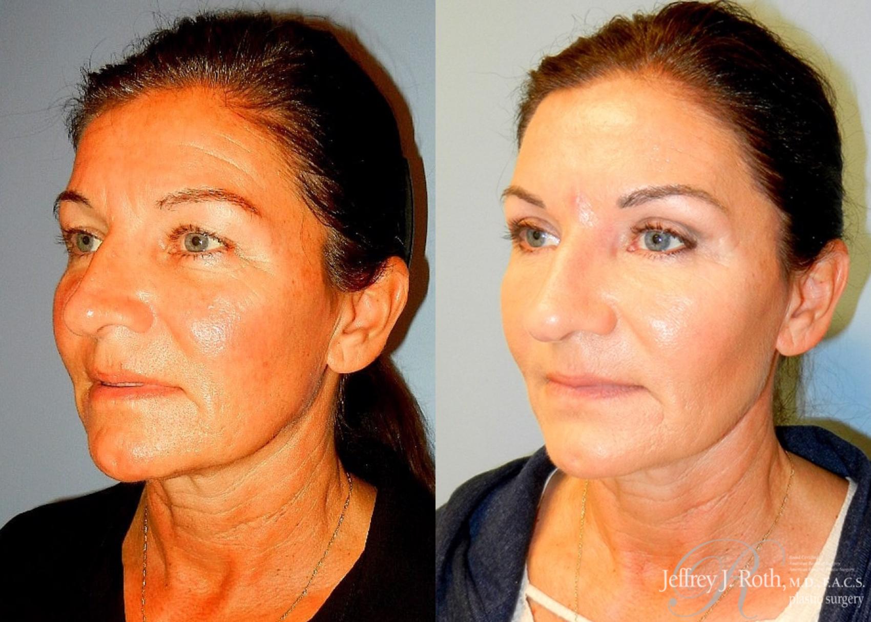 Before & After Eyelid Surgery Case 134 View #2 View in Las Vegas, NV