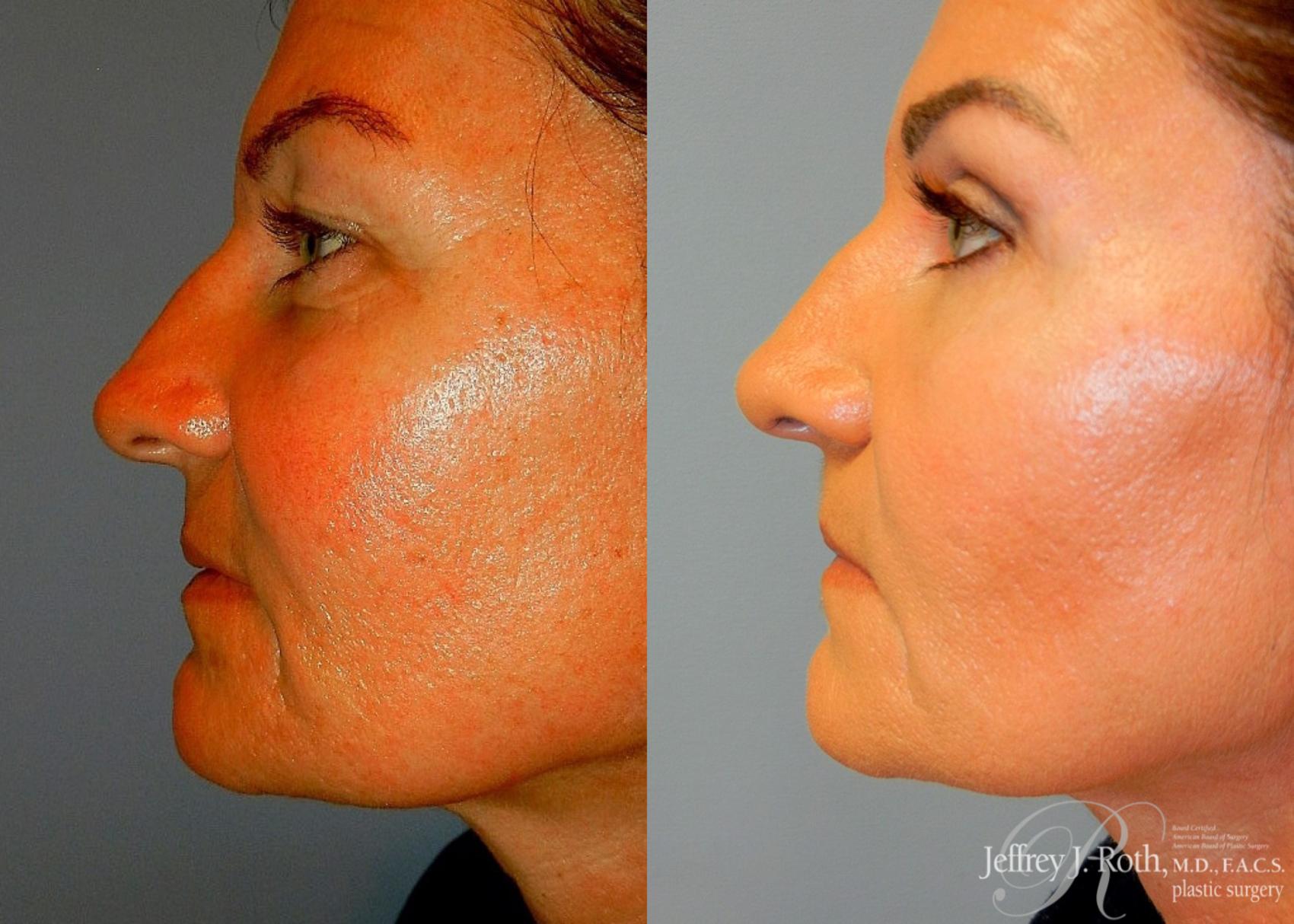 Before & After Eyelid Surgery Case 134 View #3 View in Las Vegas, NV