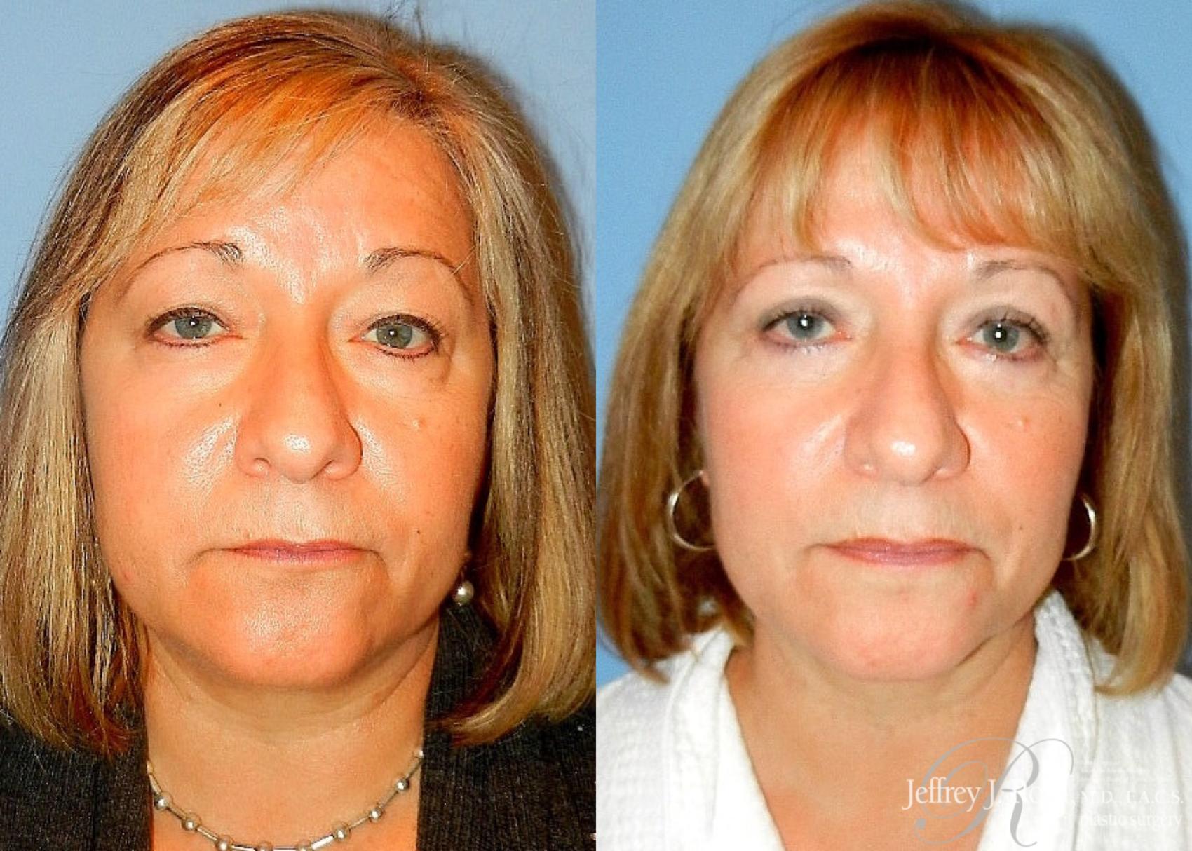 Before & After Eyelid Surgery Case 135 View #1 View in Las Vegas, NV