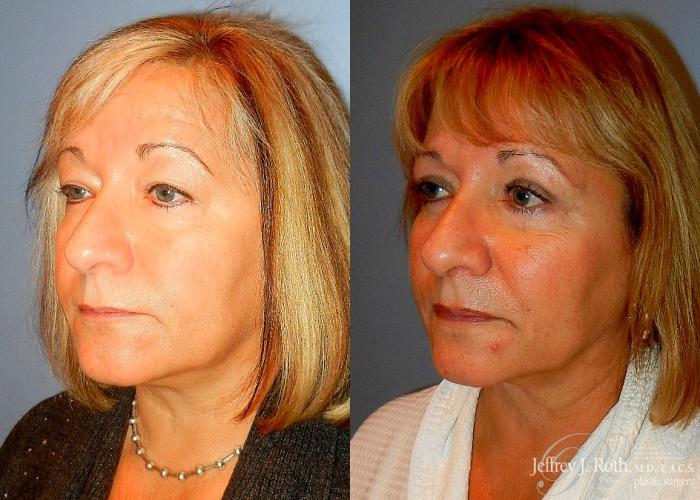 Before & After Eyelid Surgery Case 135 View #2 View in Las Vegas and Henderson, NV