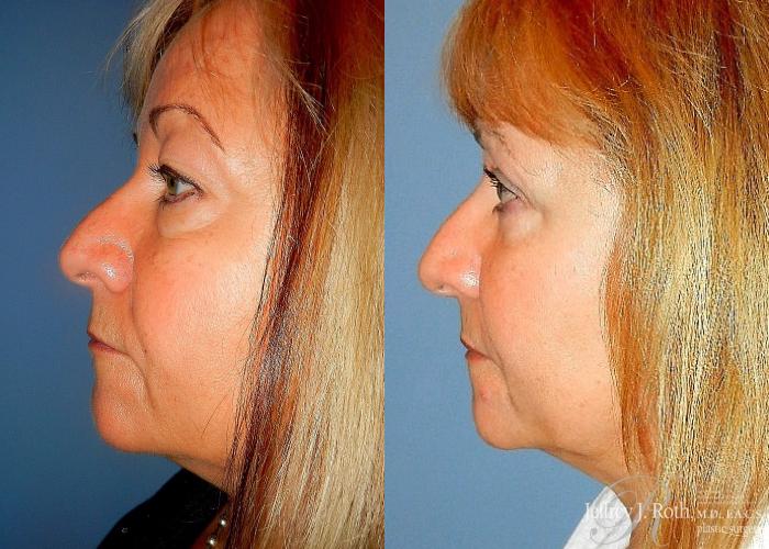 Before & After Eyelid Surgery Case 135 View #3 View in Las Vegas and Henderson, NV