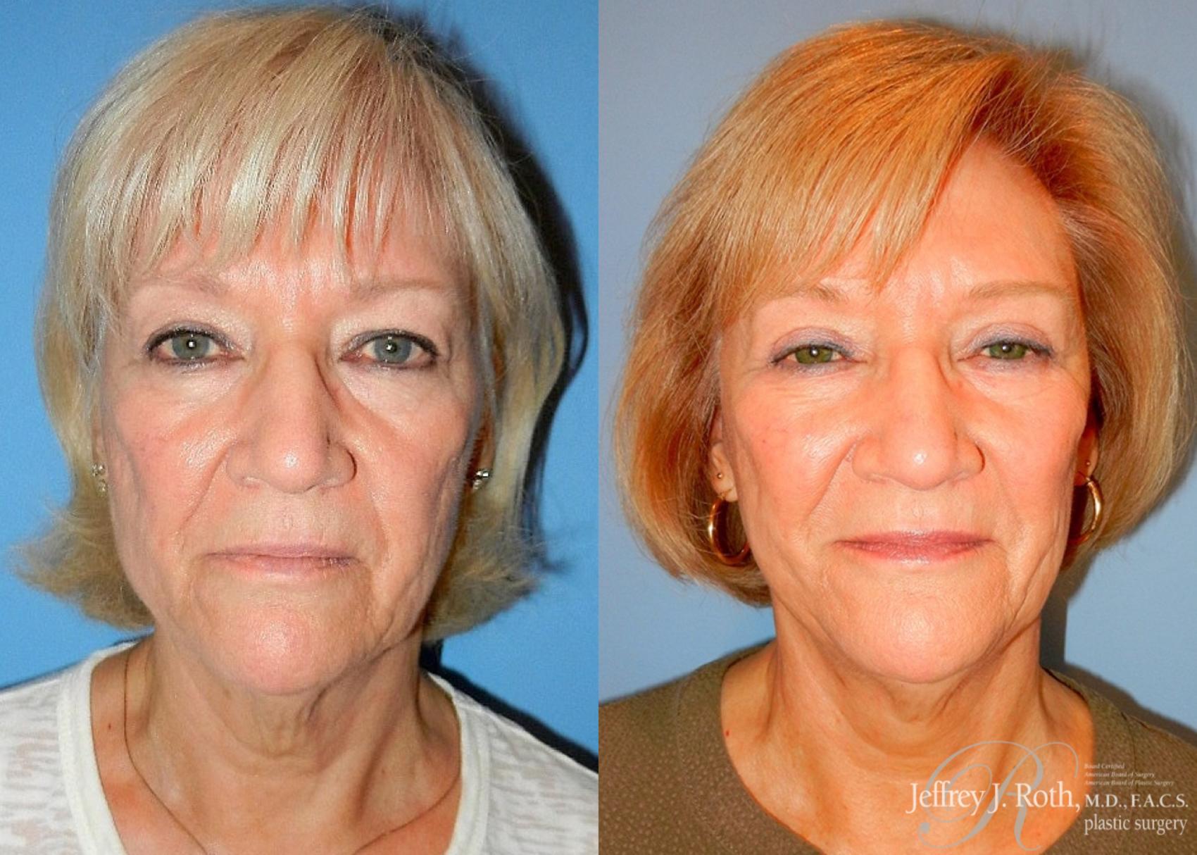 Before & After Eyelid Surgery Case 136 View #1 View in Las Vegas, NV
