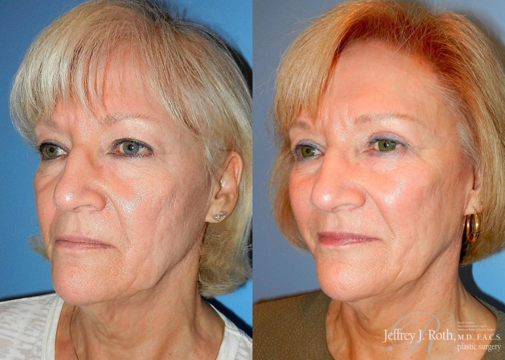 Before & After Eyelid Surgery Case 136 View #2 View in Las Vegas, NV