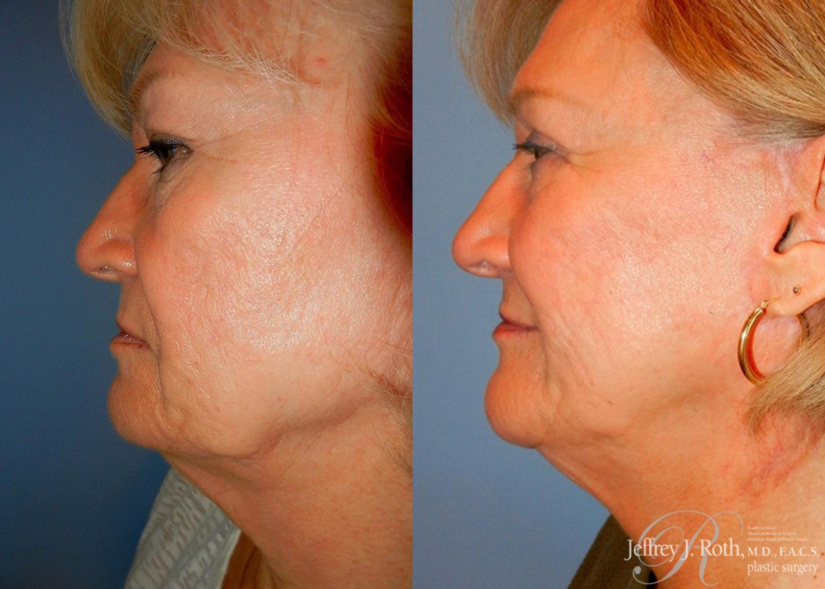 Before & After Eyelid Surgery Case 136 View #3 View in Las Vegas, NV