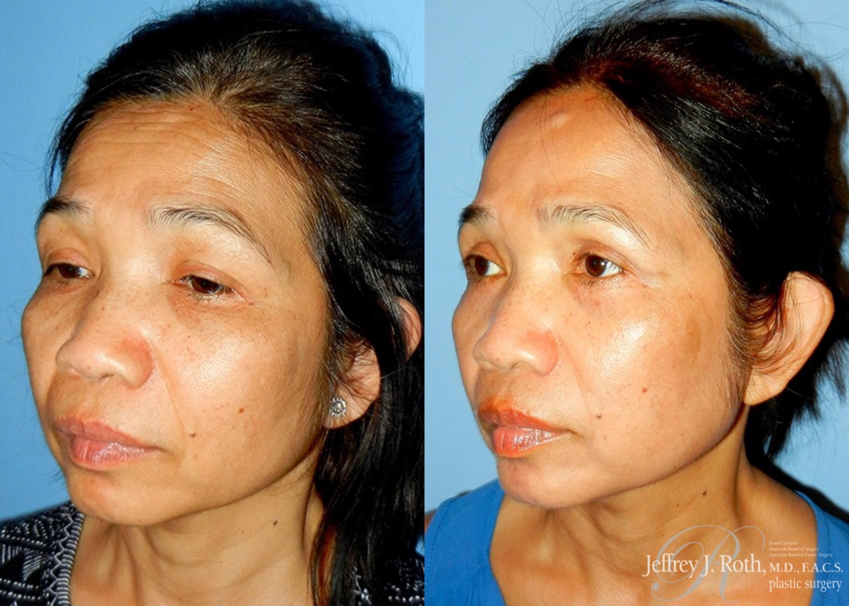 Before & After Eyelid Surgery Case 137 View #2 View in Las Vegas, NV